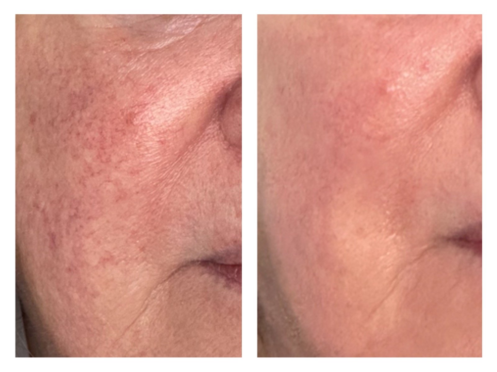 Photofacial before and after treatment results showing redness and blotchy complexion cleared up