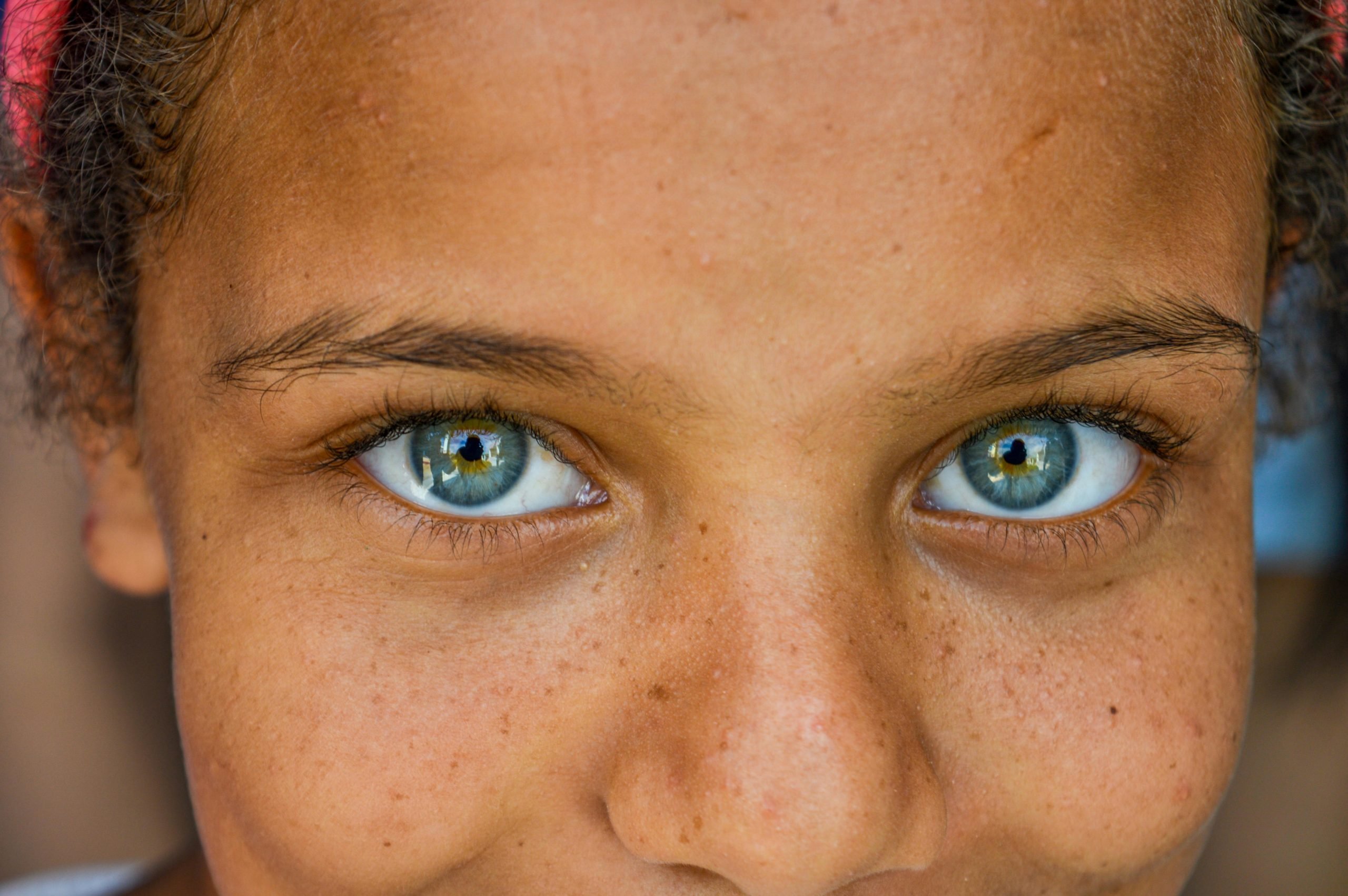 Properly cared for skin person with green eyes and freckles who knos how to prevent hyperpigmentatiion
