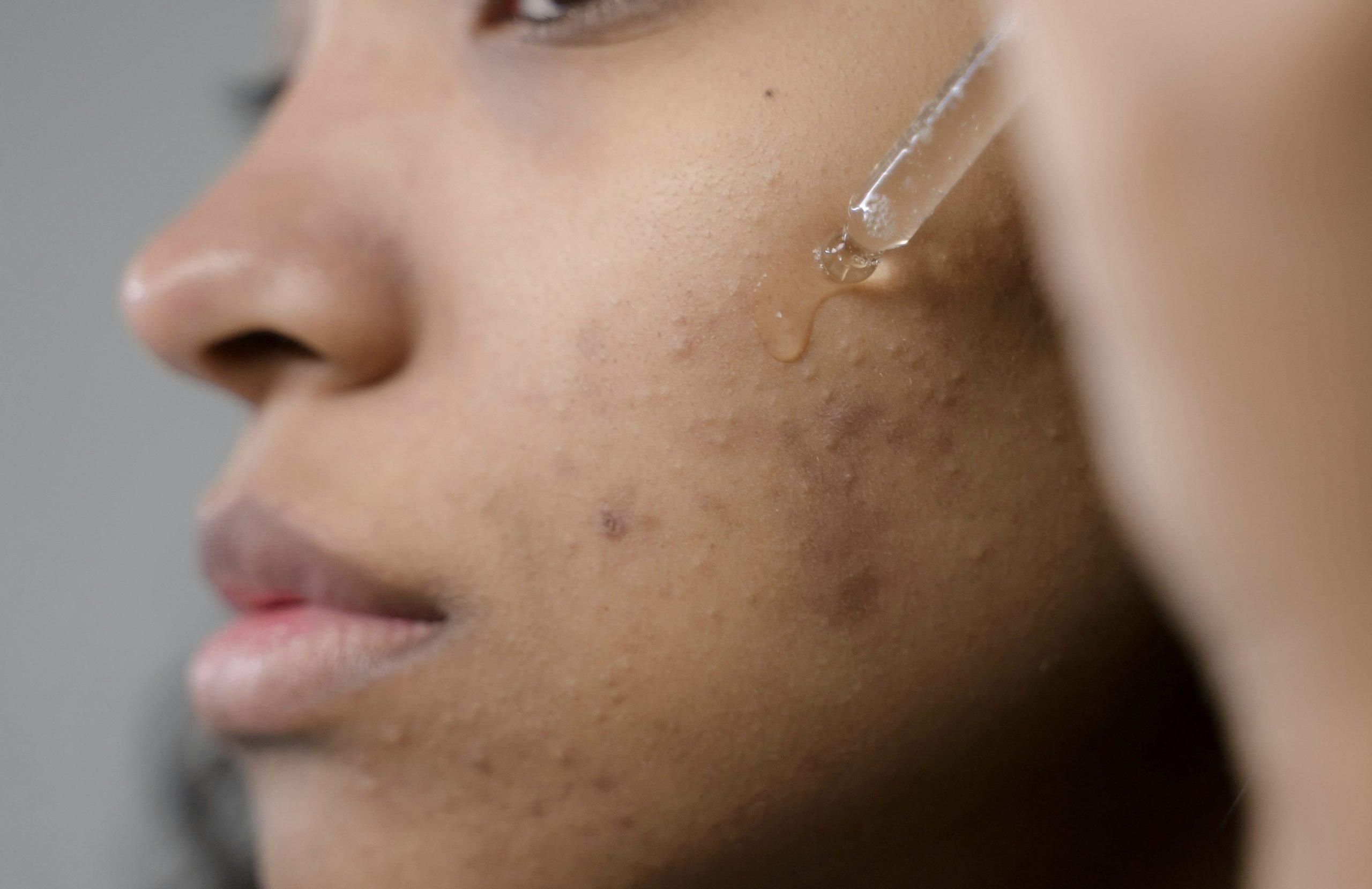 pigmented acne scars A person with pigmented acne scars