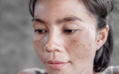 There’s a Hyperpigmentation Treatment for Every Skin Tone