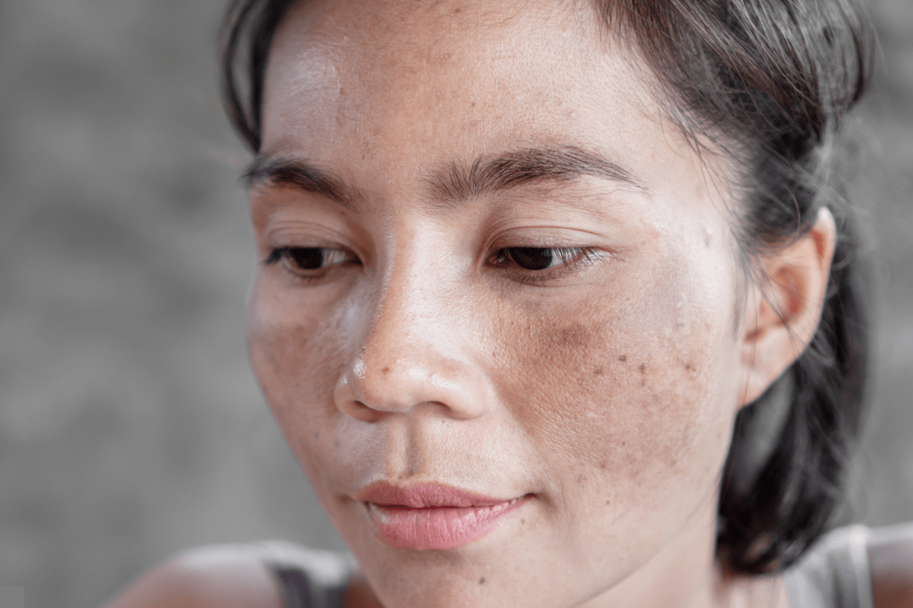 hyperpigmentation winnipeg A person with hyperpigmentation on their cheek and chin