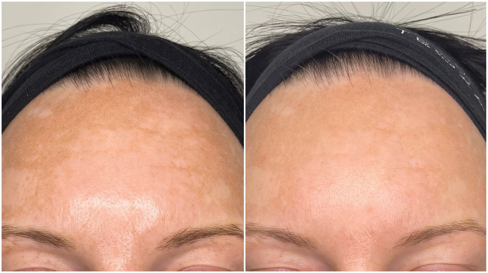 PicoSure 1 tx by Amy Before and after photos of hyperpigmentation treated with one PicoSure laser session by laser technician Amy, complemented by Vivier Hydroquinone products. Noticeable lightening of melasma and pigmented patches.