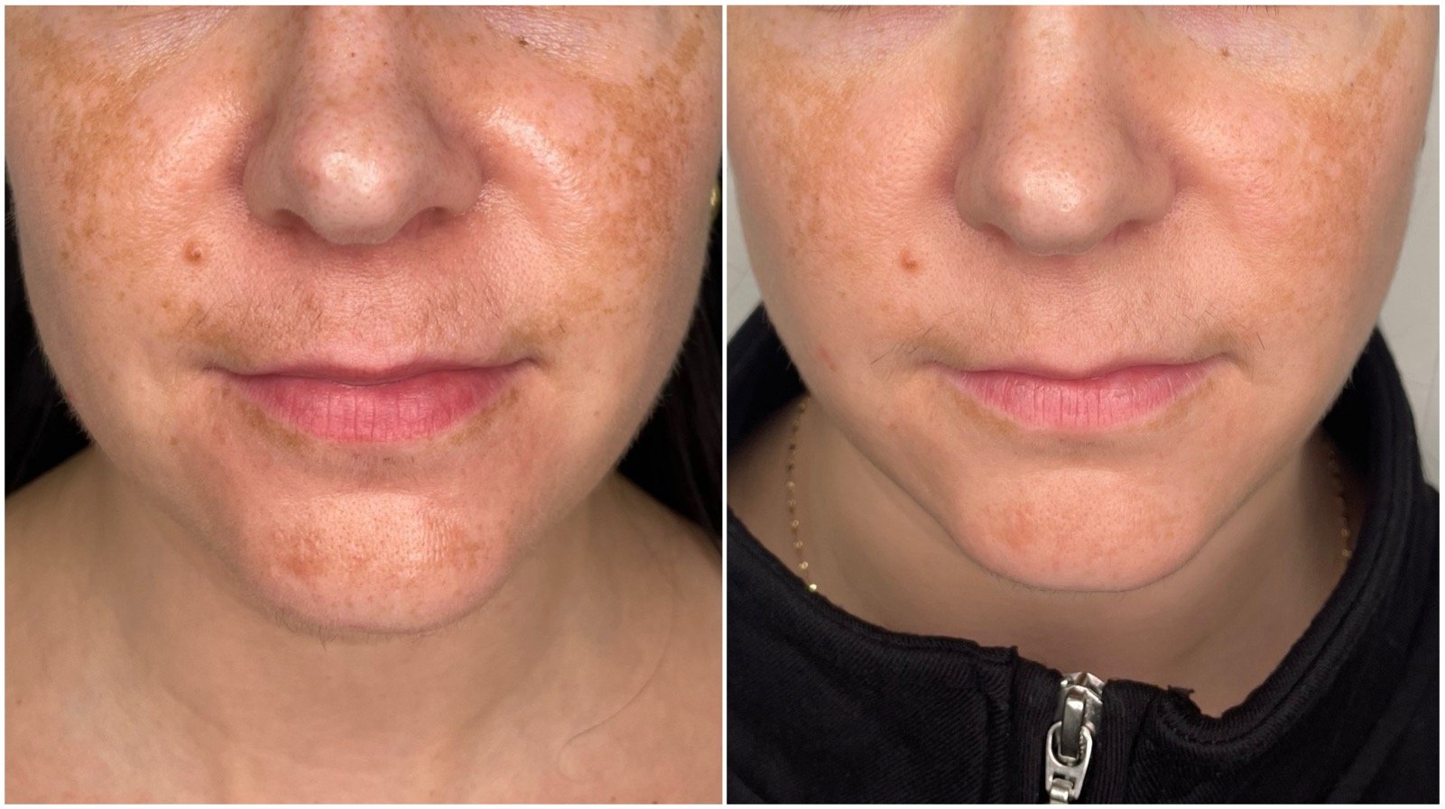 Picosure 1tx by Amy A close-up image showcasing the significant reduction of dark spots and patches after one PicoSure laser treatment for hyperpigmentation, combined with Vivier Hydroquinone products.
