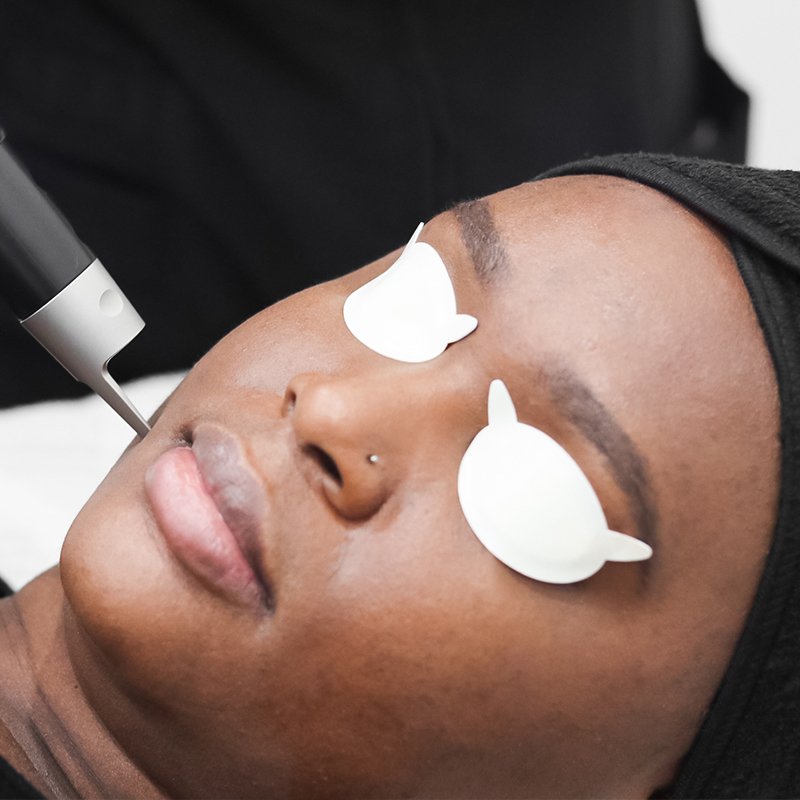 Woman receiving laser pigmentation treatment on side of cheek