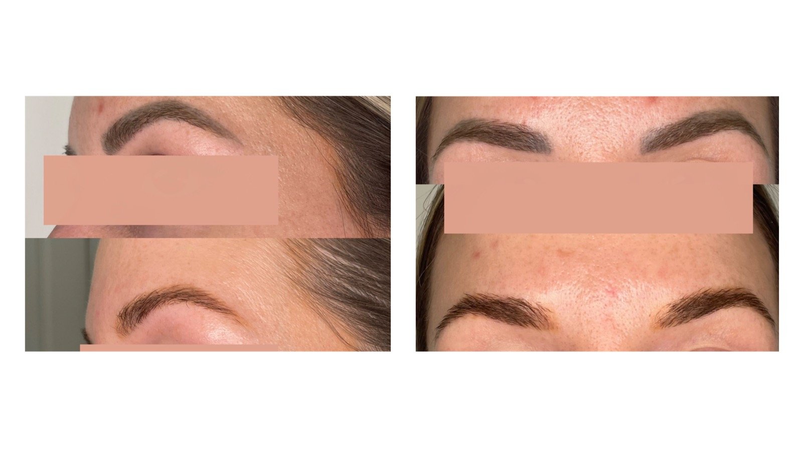 Before and after microblading removal