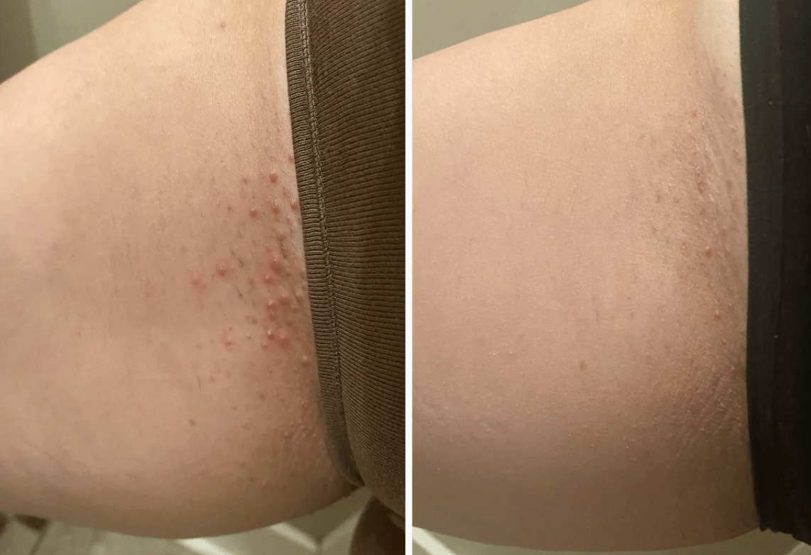 Two images side by side displaying skin improvement after using Bush Balm, highlighting a reduction in ingrown hairs, irritation, and enhanced overall skin texture and hydration.