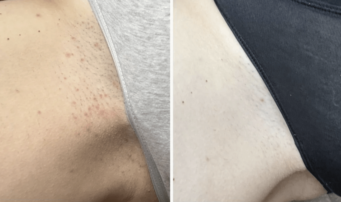 Side-by-side images showcasing skin before and after using Bush Balm, emphasizing smoother texture, reduced ingrown hairs, and improved hydration.