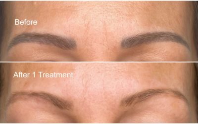 Brows Gone Wrong? How Micropigmentation Brow Removal in Winnipeg Can Help Fix It