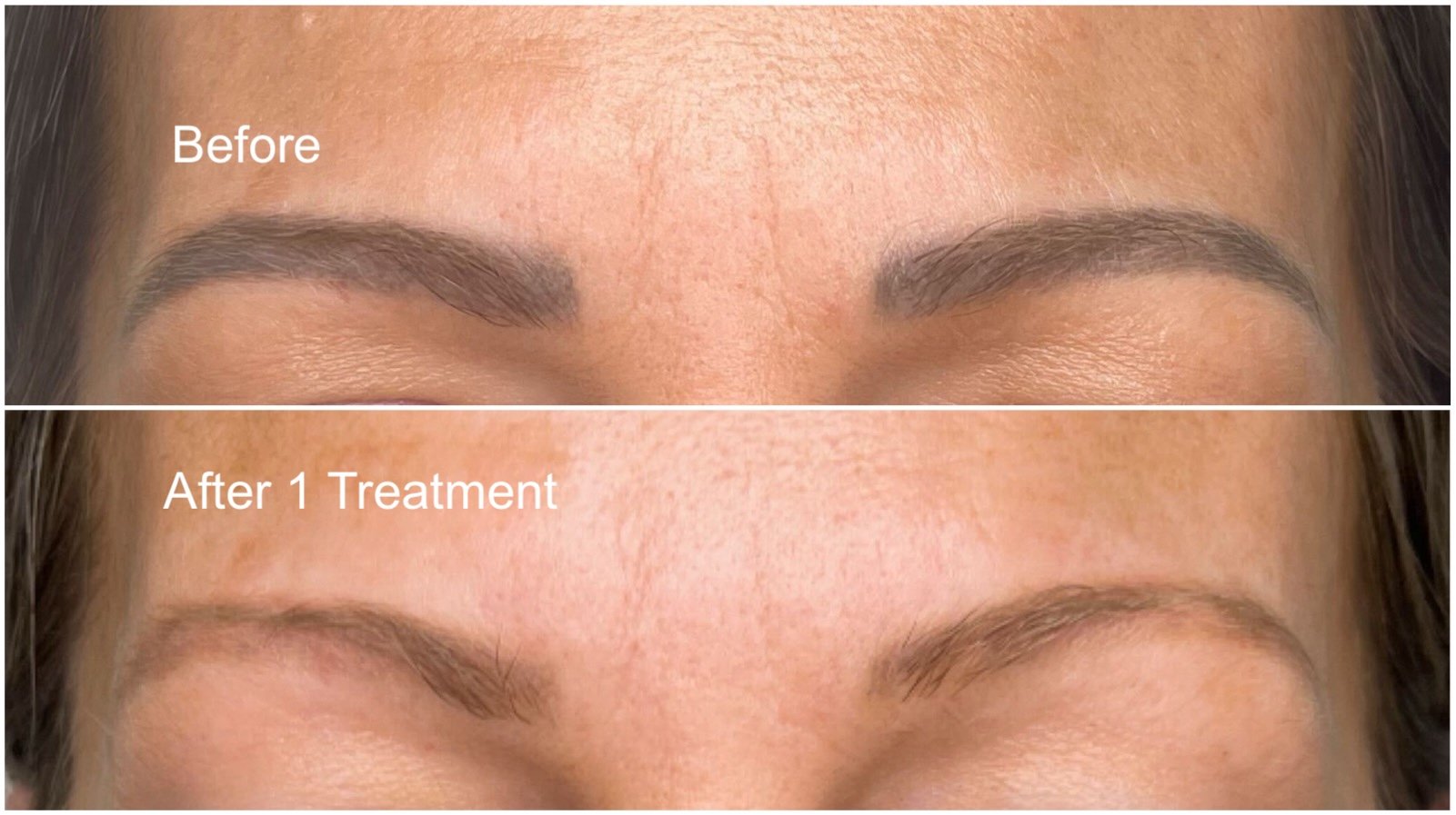 Before and after brow micropigmentation removal in winnipeg