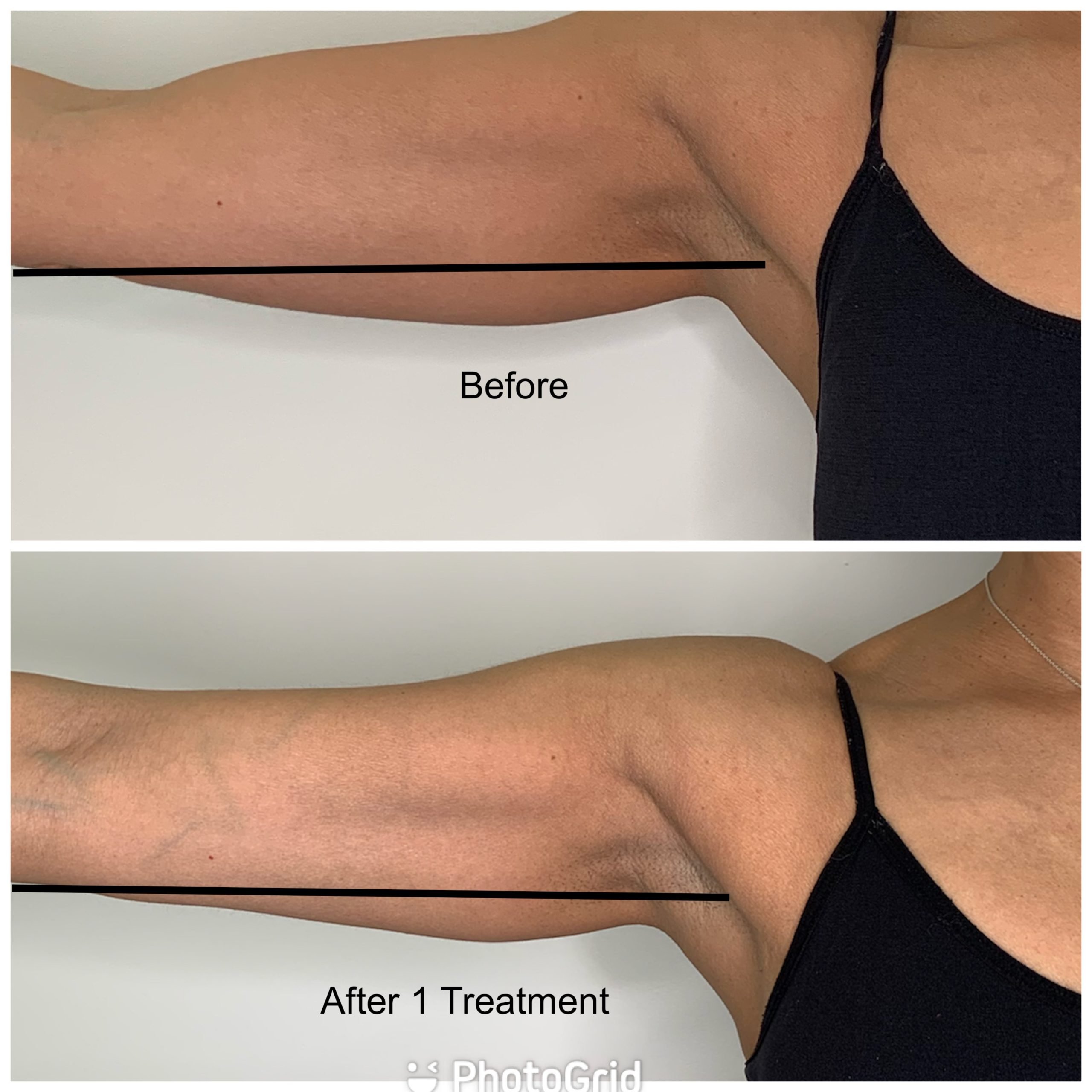 results on arm after one body sculpting in winnipeg treatment with RF Body Contouring