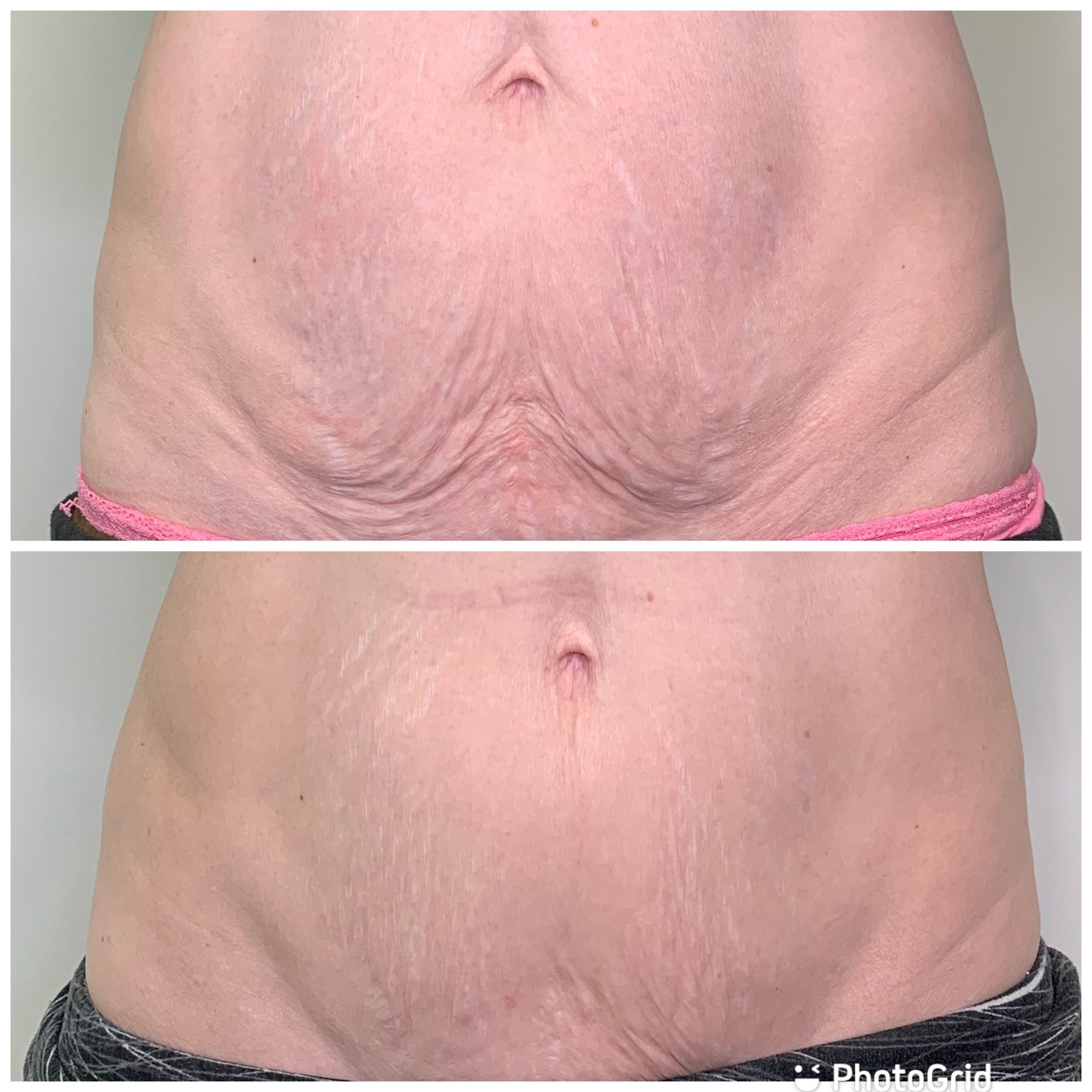 results on abdomen after body sculpting in winnipeg treatment with RF Body Contouring
