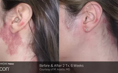 Scar Removal in Winnipeg
