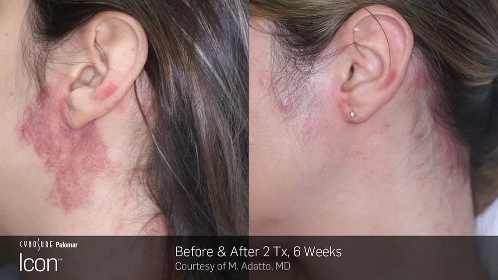 Scar removal in Winnipeg results following fractional laser treatment for smoother skin