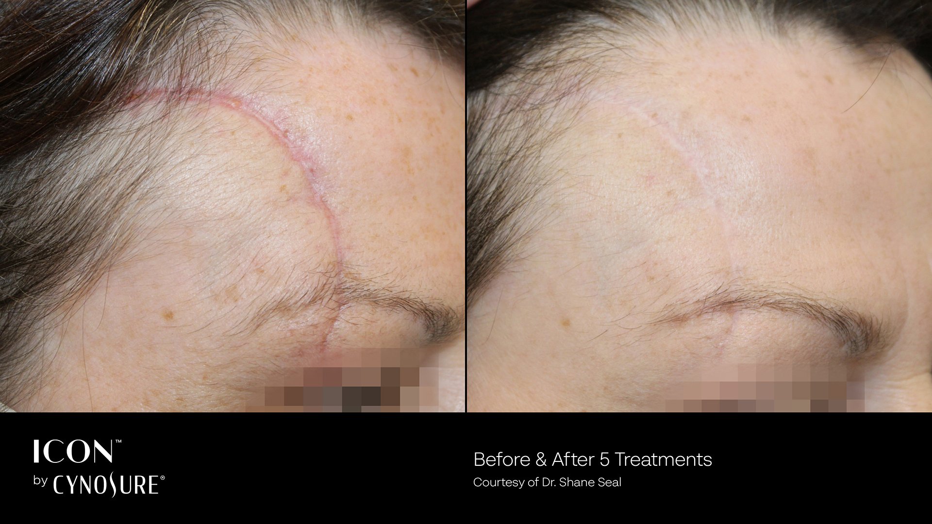 Before and after image showing fractional laser scar removal results in Winnipeg