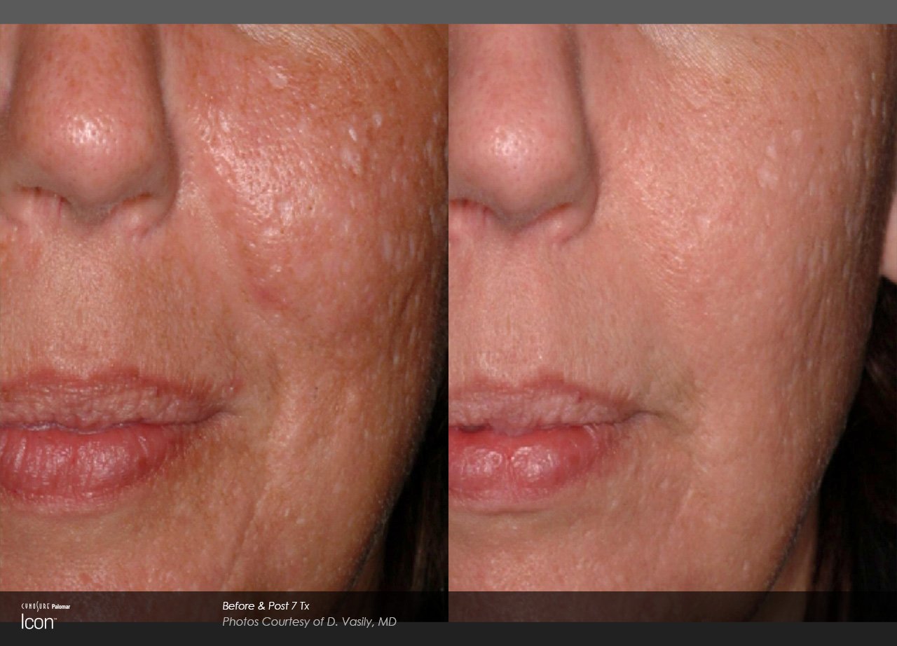 Visible improvement in skin texture from scar removal in Winnipeg