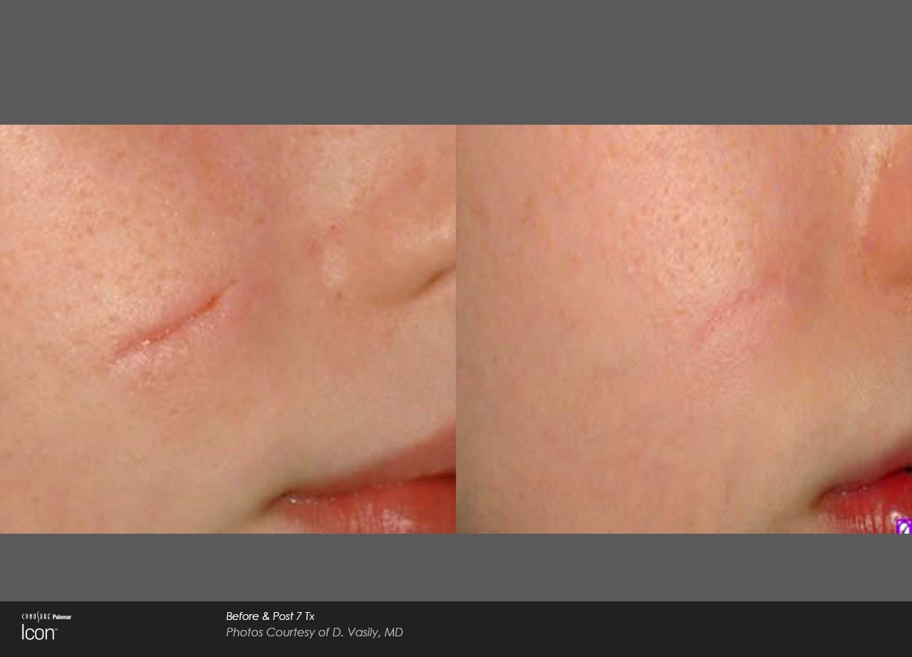 Side-by-side comparison of scar appearance before and after scar removal in Winnipeg