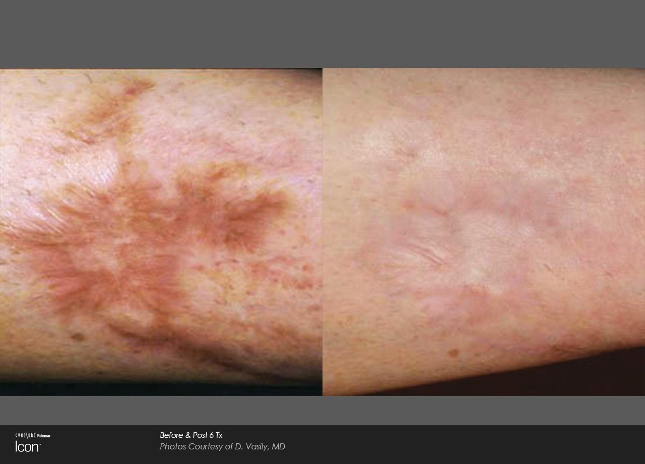 Laser scar removal progress after multiple fractional laser sessions