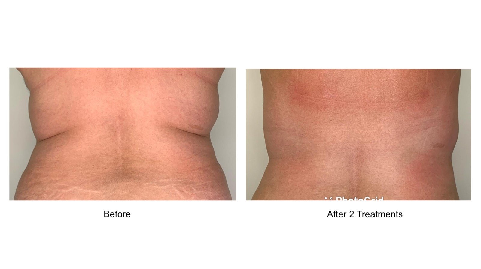 Before-and-after results following just 2 FlexSure RF body contouring treatments—non-invasive body sculpting done right here in Winnipeg.<br />
