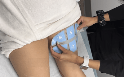 Skin Tightening Benefits of RF Body Sculpting in Winnipeg (What Clients Love Most)