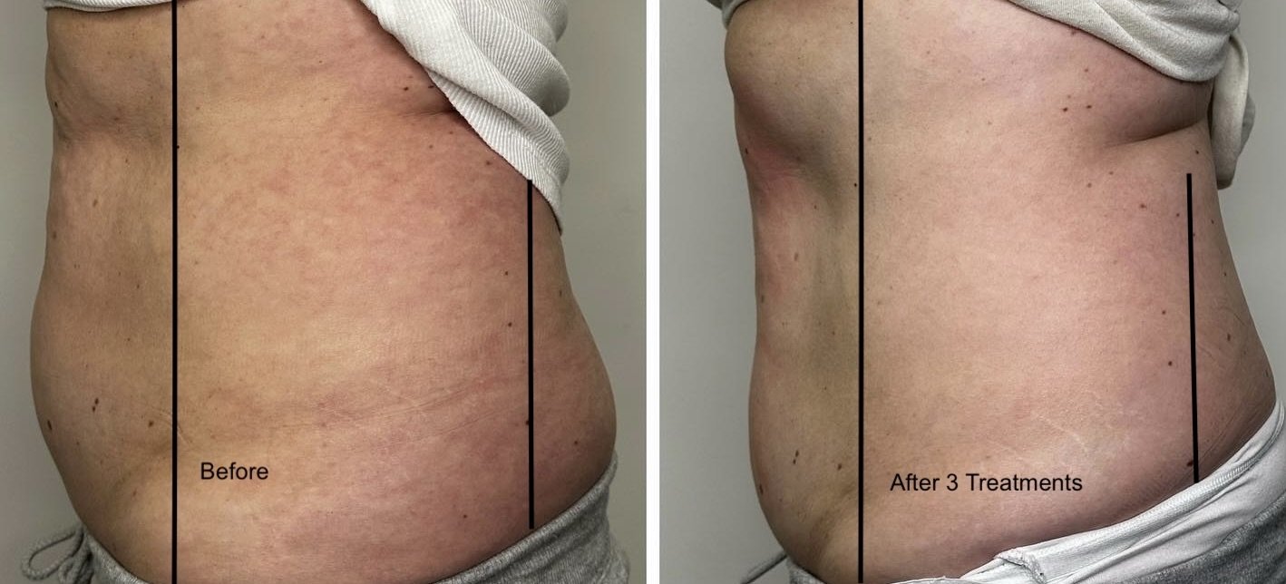 results showing before and afterof 3 flexsure rf body contouring body sculpting treatments in winnipeg