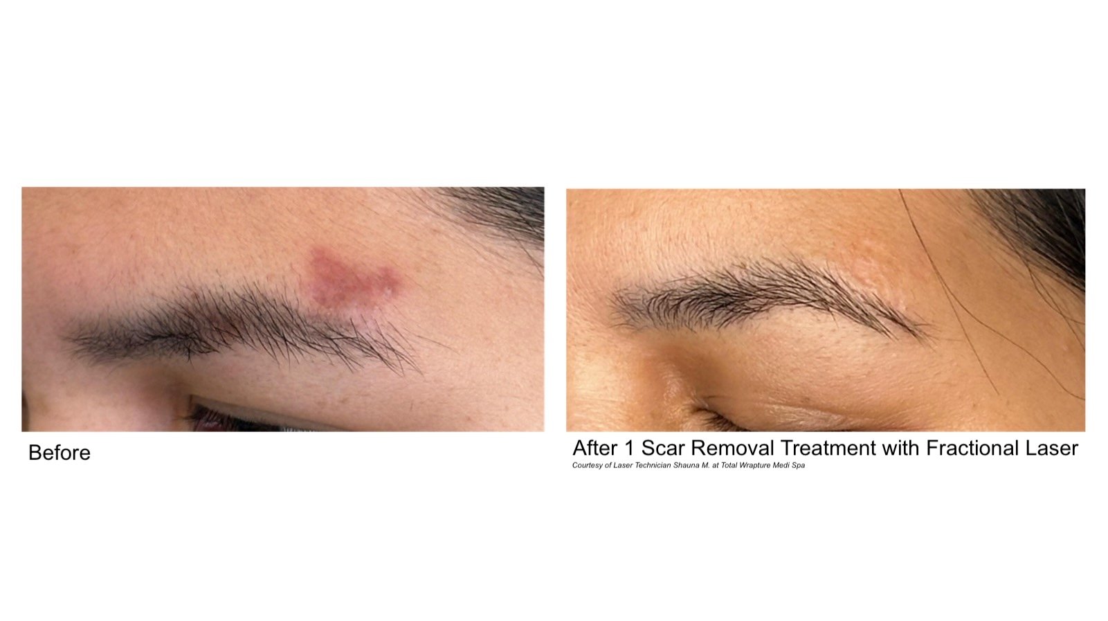 ractional laser used for scar removal in Winnipeg with clear before and after results