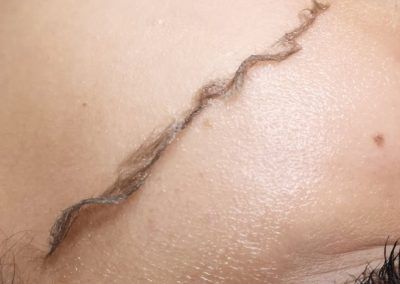 Dermaplaning Results at Total Wrapture Medi Spa Winnipeg Skin Clinic