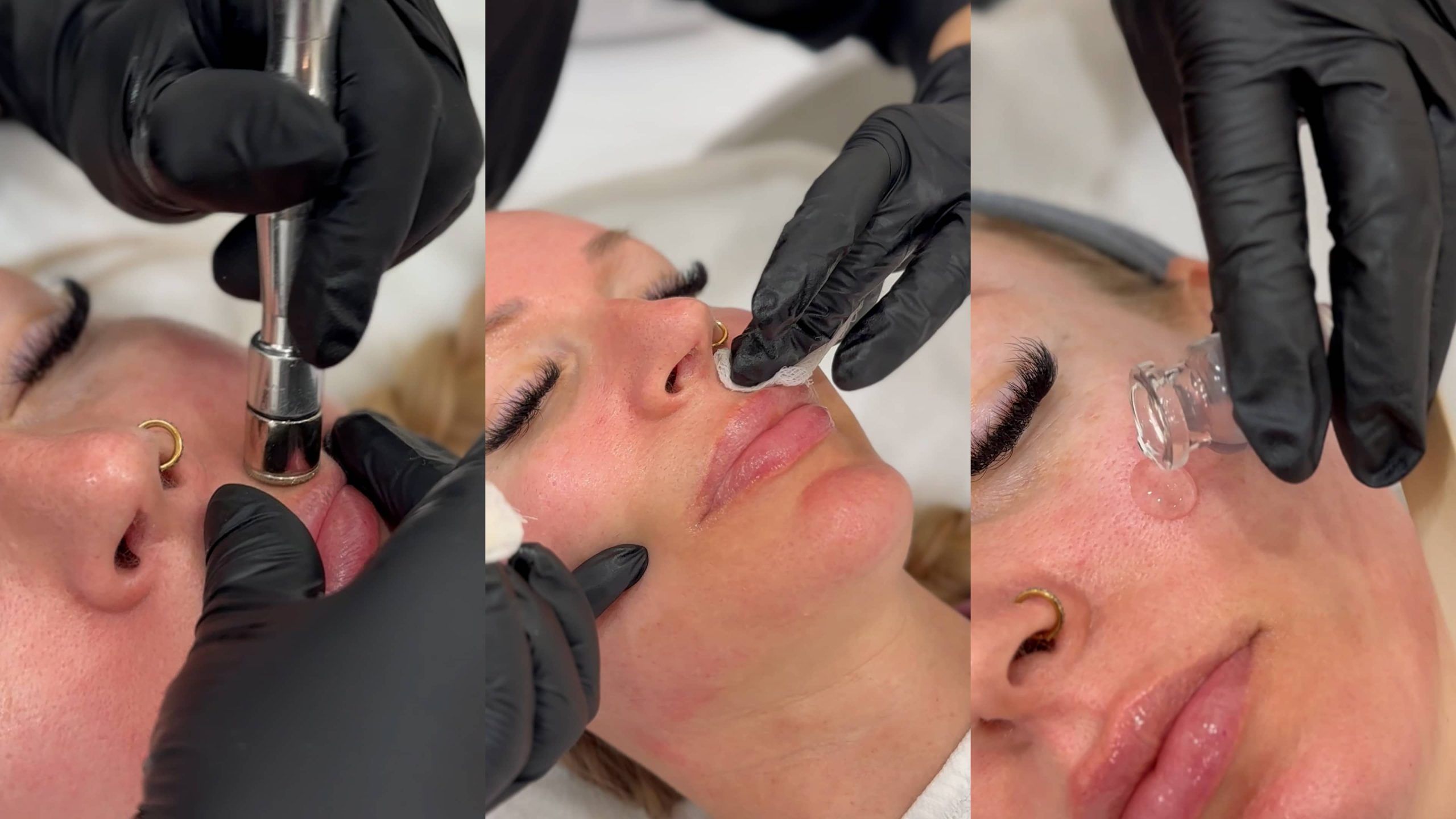 exosome facial in winnipeg with microdermabrasion Esthetician applying exosome serum during a dermaplaning facial as part of an exosome facial in Winnipeg
