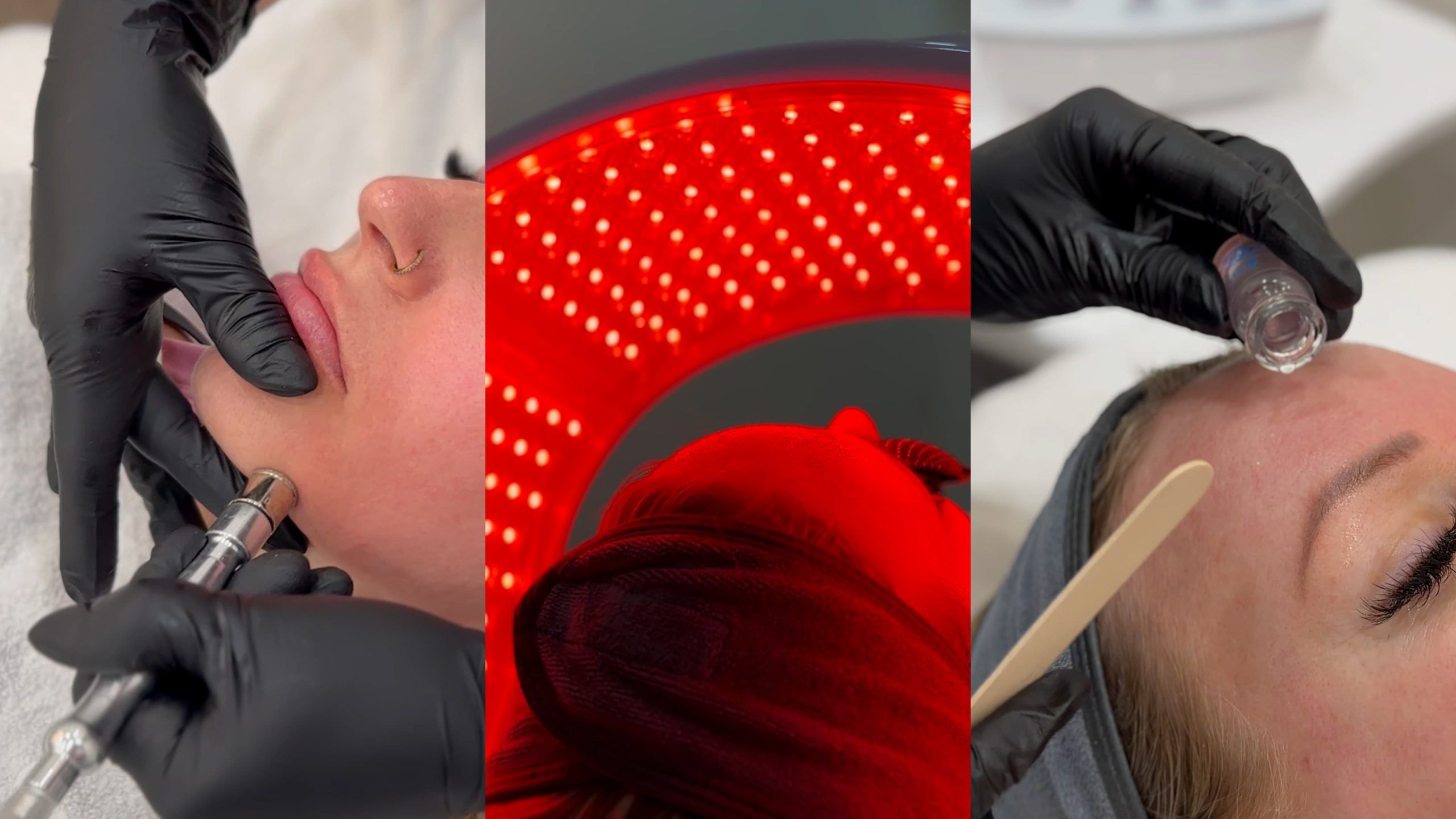 exosomes treatment with led light therapy and microdermabrasion facial treatment in progress as part of an exosome facial in Winnipeg with advanced skincare technology