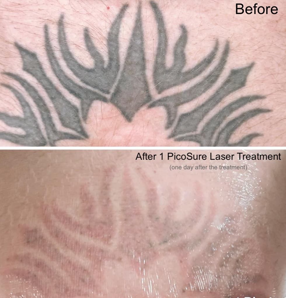 Visible fading just one day after first session. Laser tattoo removal using PicoSure in Winnipeg, performed by Shauna.