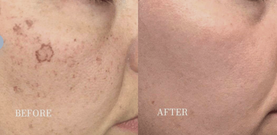 Before and after results of Age Spots Removal Winnipeg
