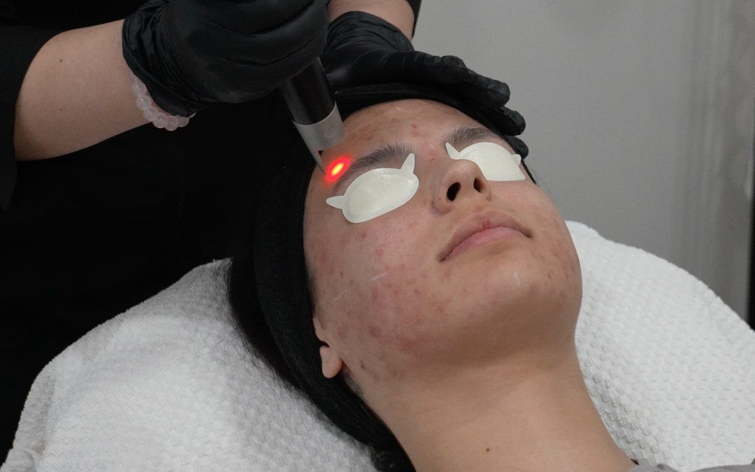 A guest with acne receiving PicoSure laser treatment for acne scars at Total Wrapture Medi Spa in Winnipeg—targeting pigmented marks for clearer, more even-toned skin.
