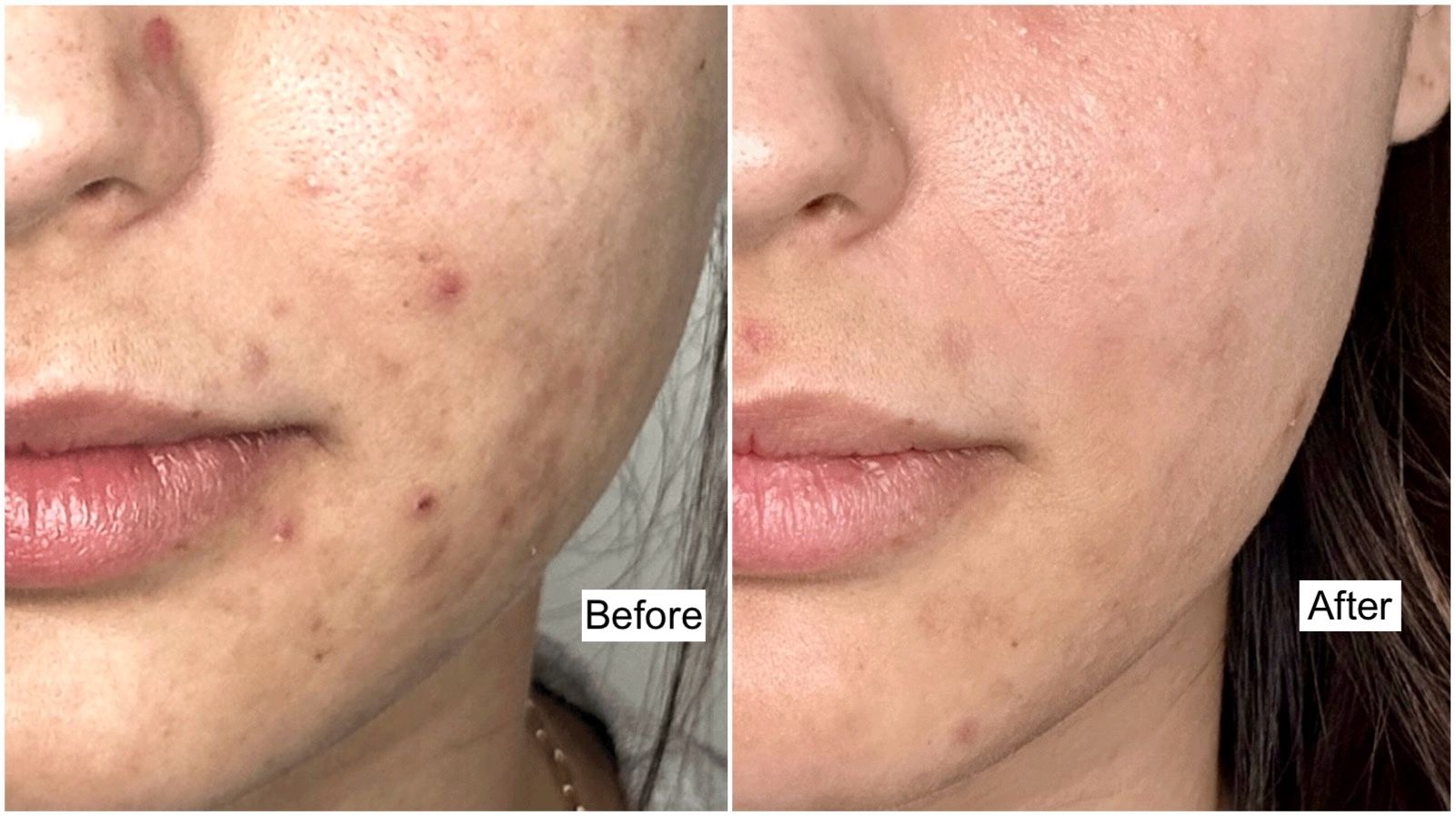 Before and after photos showing visible improvement in acne scars and pigmentation after 2 PicoSure laser treatments in Winnipeg—skin looks smoother and more even.