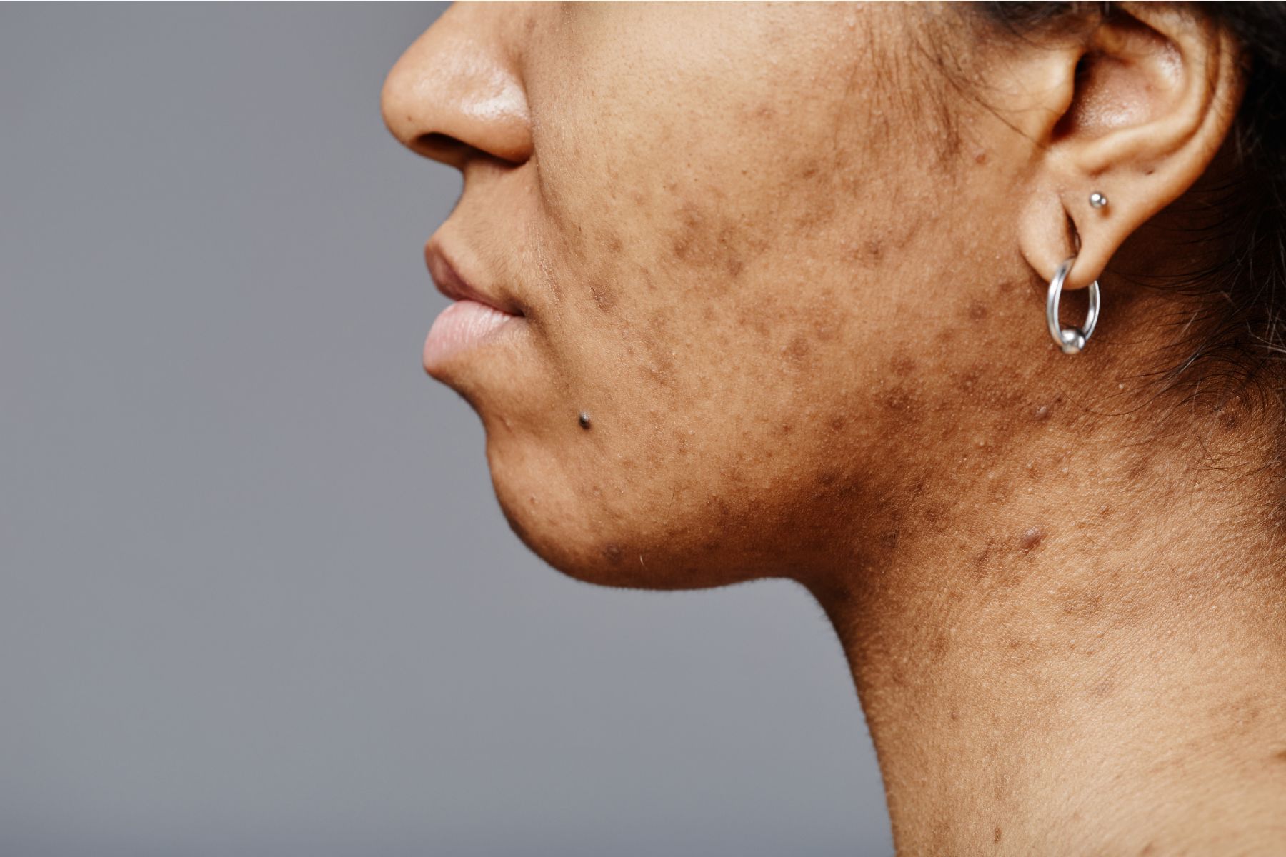Side profile of a woman with visible pigmented acne scars and active bumps. This illustrates why people ask: Can you treat acne and acne scars at the same time?