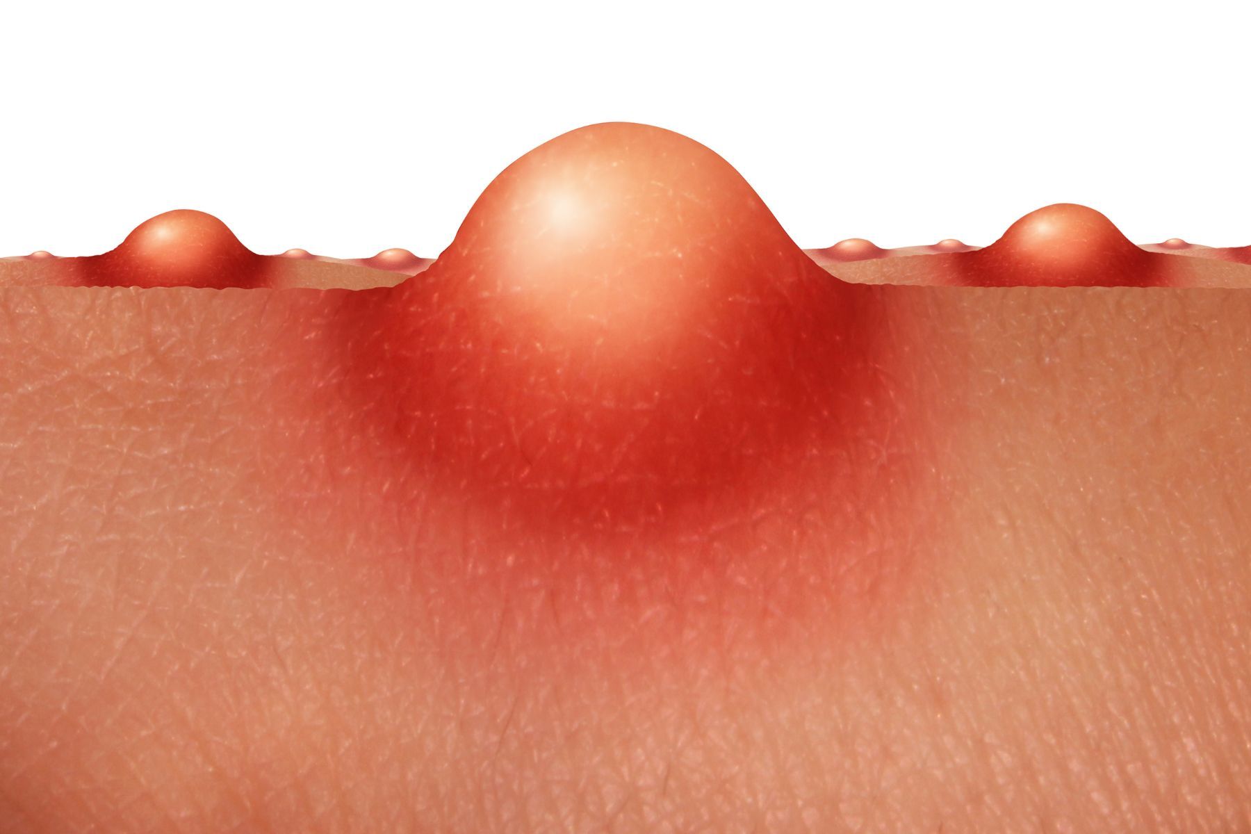 Digital illustration showing inflamed acne pustules forming under the skin. A visual starting point for explaining: Can you treat acne and acne scars at the same time?