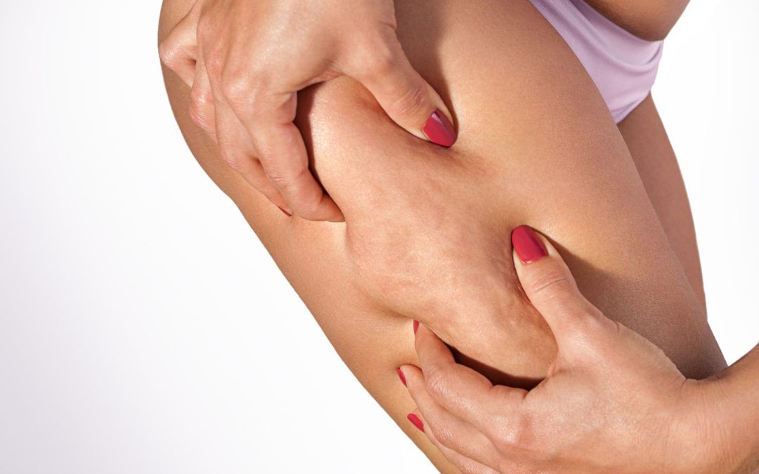 Close-up of a woman pinching thigh skin to show cellulite dimples, related to how to get rid of cellulite treatments in Winnipeg