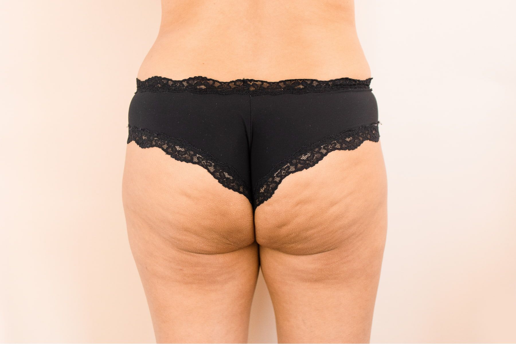 Close-up of the back of a woman’s thighs and buttocks wearing black lace underwear, showing visible cellulite