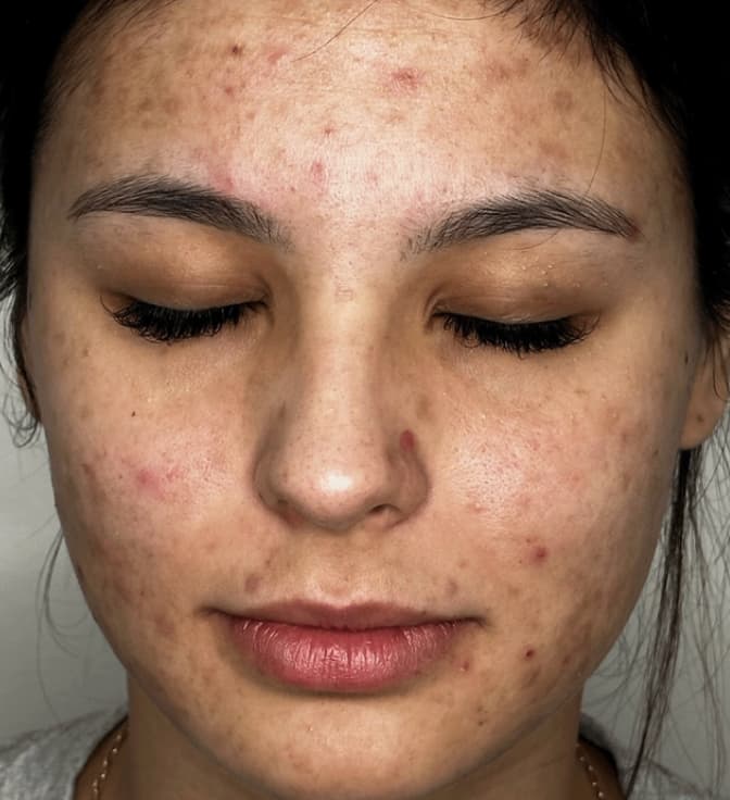 Close-up of a woman’s face with closed eyes, showing visible acne scars, redness, and post-inflammatory pigmentation across her forehead, cheeks, and chin.