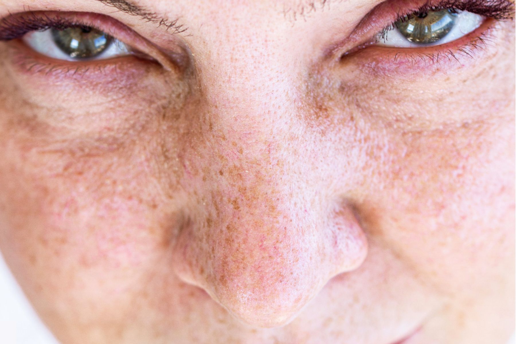 Close-up of a woman’s face showing freckles, large pores, fine lines, redness, and pigmentation across the nose and cheeks, highlighting sun damage for “How to Fix Your Skin After Summer.”