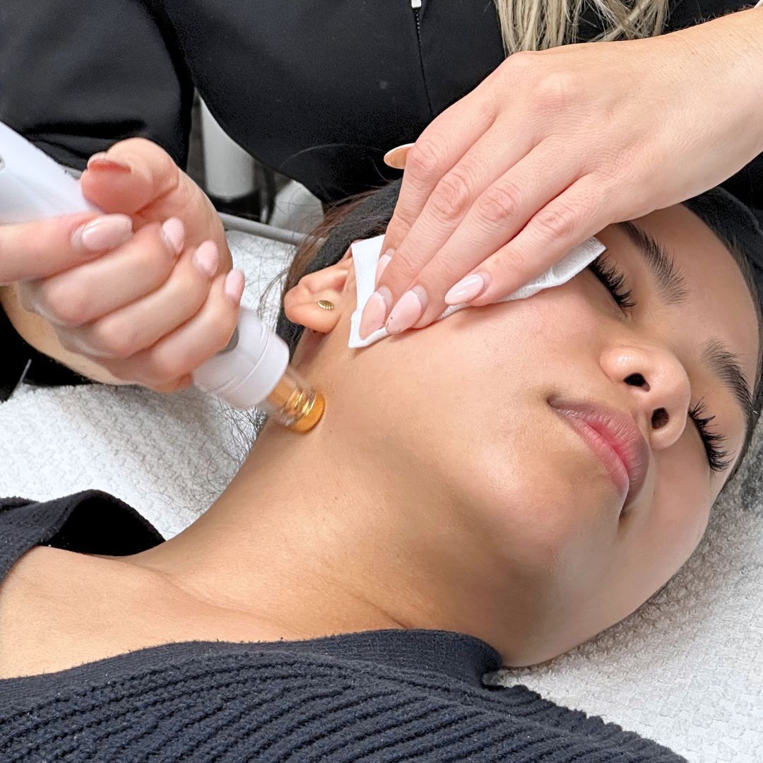 A woman receiving a non-invasive RF face tightening treatment at a spa, with a technician using a handheld device along her jawline to stimulate collagen and firm the skin.