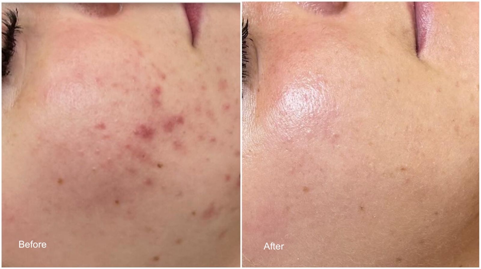 Before and after results of acne facials and customized skincare by Meagan at Total Wrapture Medi Spa in Winnipeg. The “before” images display visible acne and redness, while the “after” images show clearer skin, minimized blemishes, and improved overall complexion.