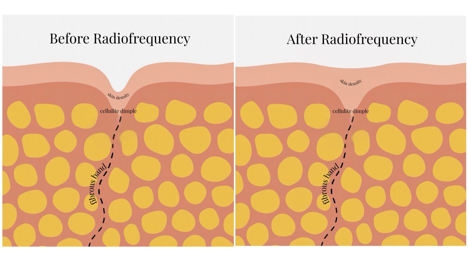 Side-by-side illustration showing skin cross-sections before and after radiofrequency treatment for cellulite. The “Before” image shows a pronounced cellulite dimple caused by a fibrous band pulling down on the skin. The “After” image shows smoother skin with reduced dimpling. Yellow circles represent fat cells, and pink layers represent skin and connective tissue. A disclaimer reads: “For illustration only; actual results will vary depending on the individual and the number of treatments received.”