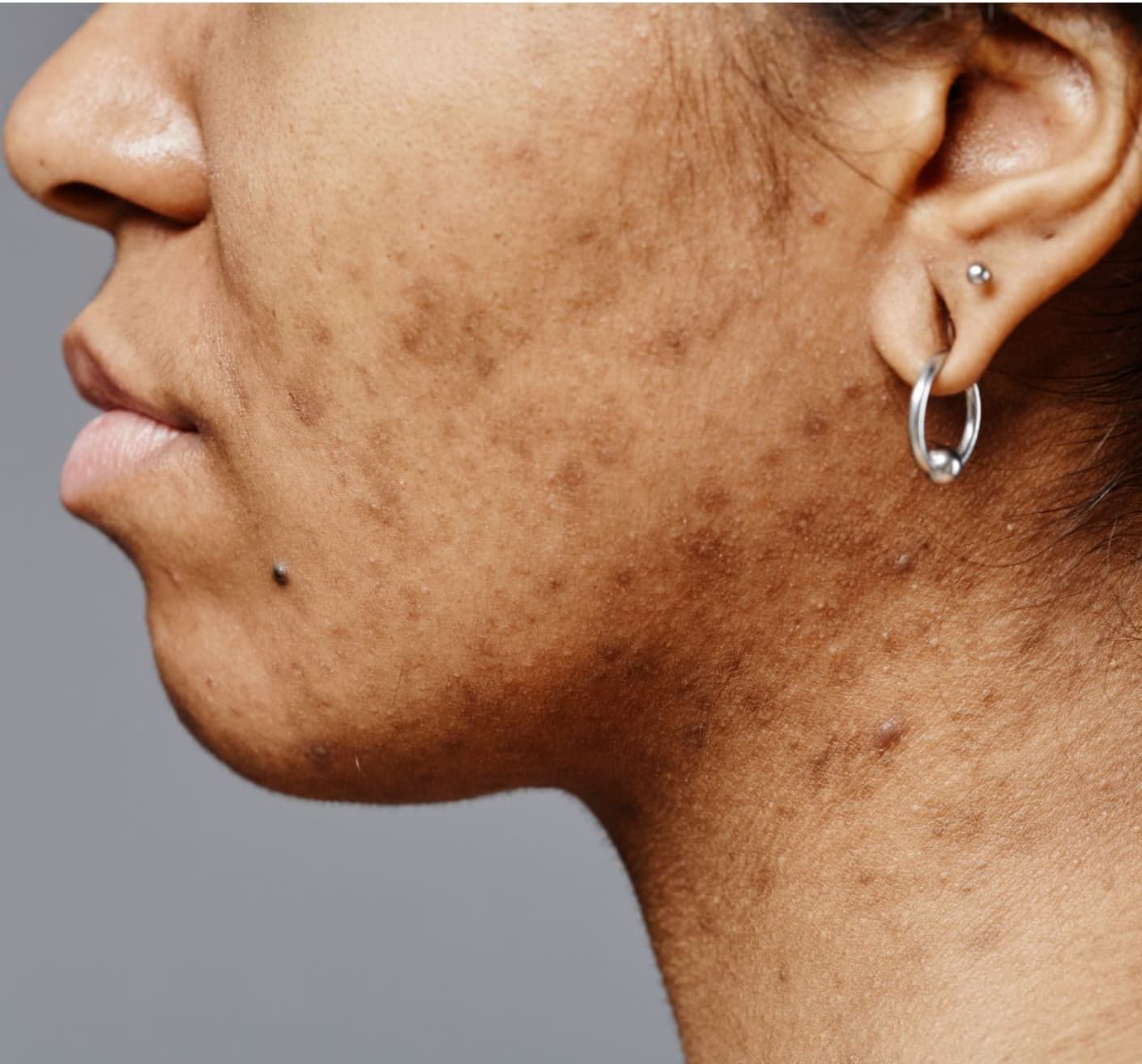Close-up of a woman’s jawline and cheek showing post-inflammatory hyperpigmentation and dark spots on brown skin