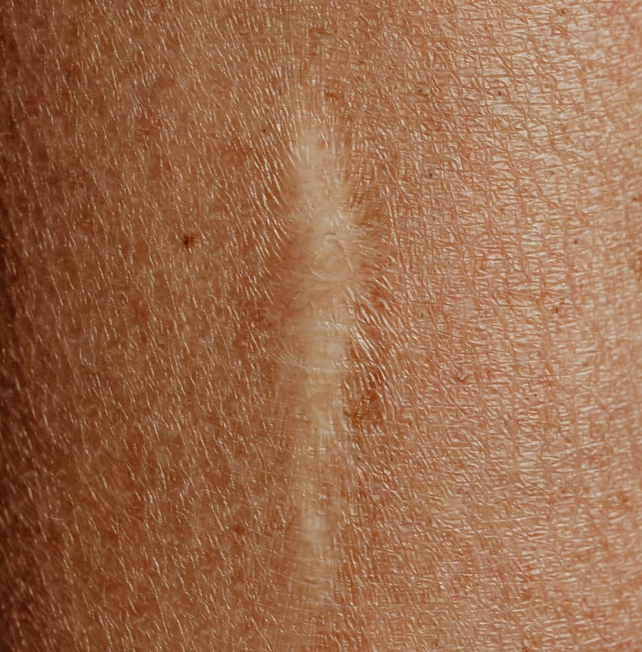 Close-up of a healed scar on human skin, showing a raised and pale linear mark, typically treated with scar reduction laser