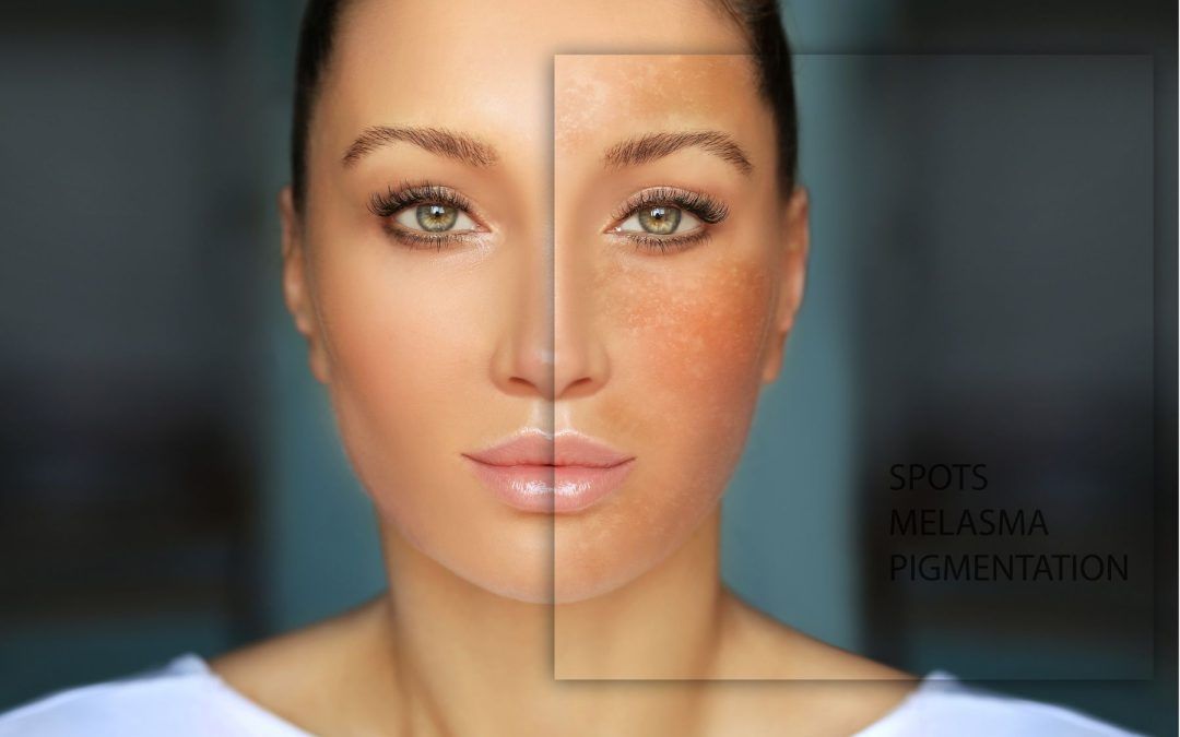 Close-up of a woman’s face showing a before-and-after effect of summer sun damage, with one side clear and smooth, and the other side displaying visible hyperpigmentation, melasma, and dark spots. Concept for “How to Fix Your Skin After Summer.”